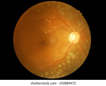 Retina Of Diabetic - Laser Scar