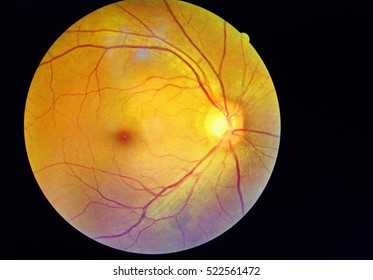  Retina and optic nerve inside a healthy human diabetic eye.