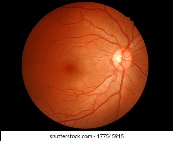 Retina And Optic Nerve Normal (Right)