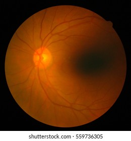 Retinal