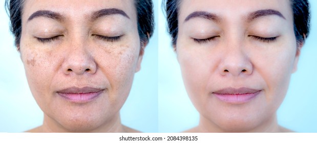 Retouched image before and after spot melasma pigmentation facial treatment on middle age asian woman face. Skincare and health problem concept. 