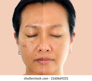 Retouched image before and after spot melasma pigmentation facial treatment on middle age asian woman face. Skincare and health problem concept. 