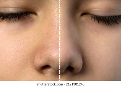 Retouched Image Compared Before And After Treatment Blackhead Acne On Teenager Boy's Nose. Beauty Process Concept.