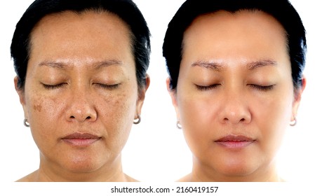 Retouched image to show before and after treatment spot melasma pigmentation facial treatment on young asian woman face. Skincare and health problem concept.	 - Shutterstock ID 2160419157