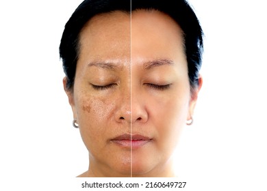 Retouched image to show before and after treatment spot melasma pigmentation facial treatment on young asian woman face. Skincare and health problem concept. - Shutterstock ID 2160649727