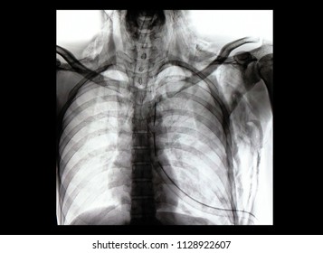 a reversed contrast chest film of a patient with chest and endotracheal tubes