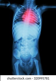 Rheumatic Heart Disease , Valvular Heart Disease  ( Film X-ray Body Of Child With Red Area At Heart ) ( Medical , Science And Healthcare Concept )