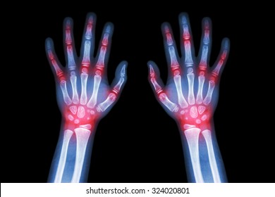 Rheumatoid Arthritis , Gout Arthritis  ( Film X-ray Both Hands Of Child With Multiple Joint Arthritis ) ( Medical , Science And Health Care Concept )