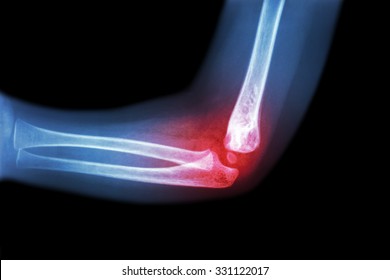 Rheumatoid Arthritis , Gouty Arthritis ( Film X-ray Child 's Elbow With Arthritis At Elbow ) ( Side View , Lateral )