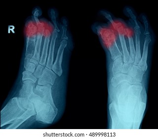 Rheumatoid Arthritis , Gouty Arthritis Film X-ray Foot