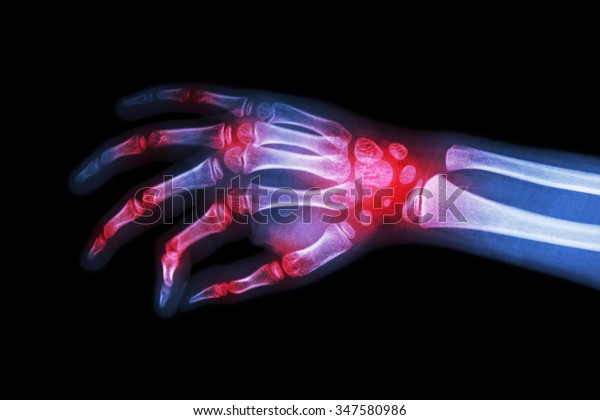 Rheumatoid arthritis ,\
Gouty arthritis ( Film x-ray hand of child with arthritis at\
multiple joint )