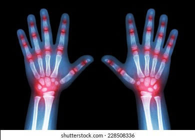 Rheumatoid Arthritis ( X-ray Both Child Hands And Multiple Joint Arthritis )