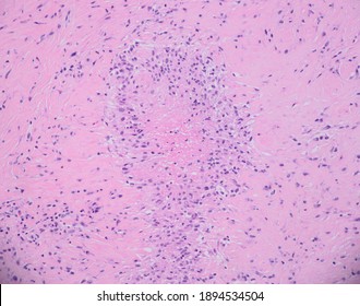 Rheumatoid Nodule Of The Elbow. Microscopic View Showing An Area Of Necrosis Surrounded By Macrophages And Fibrosis.