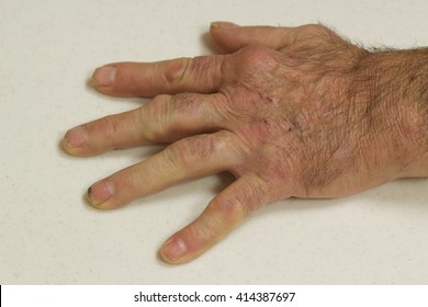 Rheumatoid Nodules In A Man With Severe Rheumatoid Arthritis