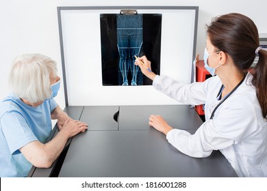 Rheumatologist consulting an elderly patient by pointing to X-ray of knee joint. Arthritis and disease of the joints of the legs