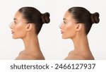 Rhinoplasty before and after. Comparison of female nose after plastic surgery, woman standing isolated on white background, side view