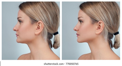 Rhinoplasty. Portrait of female face, before and after plastic surgery of the nose