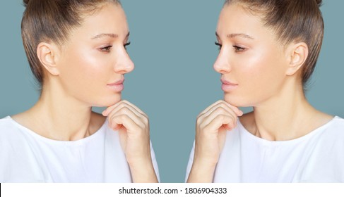 Rhinoplasty,septoplasty. Before And After Correction