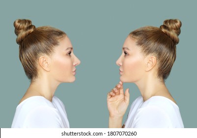 Rhinoplasty,septoplasty. Before And After Correction