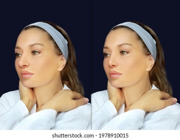 Rhinoplasty,septoplasty. Before And After Correction