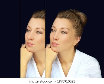 Rhinoplasty,septoplasty. Before And After Correction