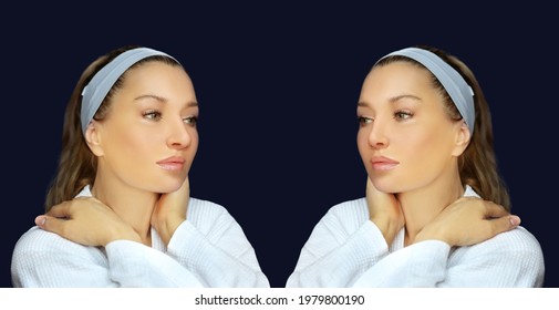 Rhinoplasty,septoplasty. Before And After Correction