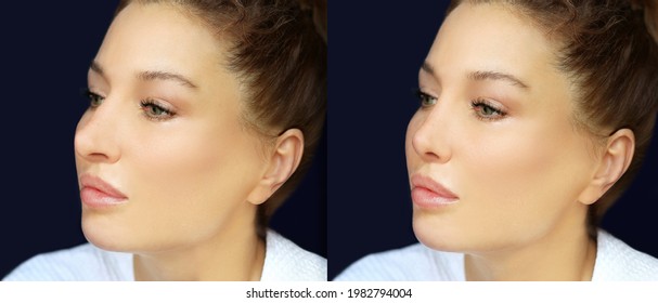 Rhinoplasty,septoplasty. Before And After Correction