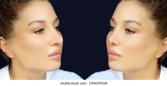 Rhinoplasty,septoplasty. Before And After Correction