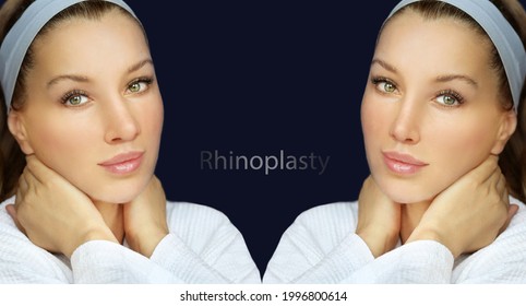 Rhinoplasty,septoplasty. Before And After Correction