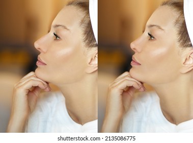 Rhinoplasty,septoplasty. Before And After Correction