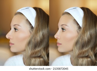 Rhinoplasty,septoplasty. Before And After Correction