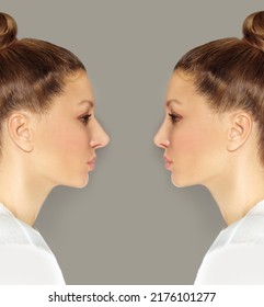 Rhinoplasty,septoplasty. Before And After Correction