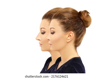 Rhinoplasty,septoplasty. Before And After Correction