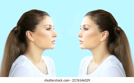 Rhinoplasty,septoplasty. Before And After Correction