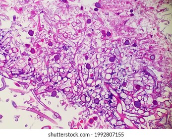 Rhizopus Fungal Hyphae In Tissue Biopsy Specimen