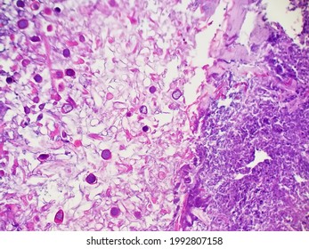 Rhizopus Fungal Hyphae In Tissue Biopsy Specimen