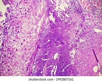 Rhizopus Fungal Hyphae In Tissue Biopsy Specimen