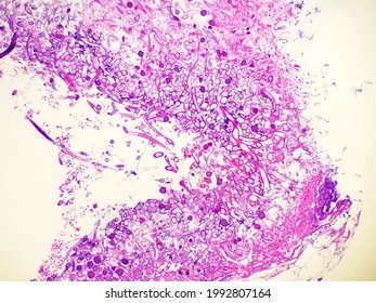 Rhizopus Fungal Hyphae In Tissue Biopsy Specimen