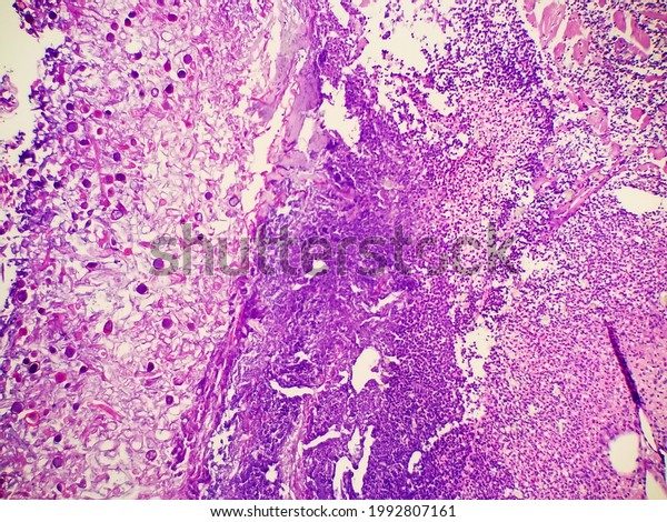 Rhizopus Fungal Hyphae Tissue Biopsy Specimen Stock Photo 1992807161 