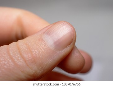 Ridged fingernail of a thumb finger of a caucasian woman with vertical ridges. Very short cut nails.