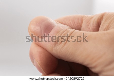 Ridged fingernail of a thumb finger of a man with vertical ridges on white background
