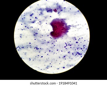 Right Axillary Swelling Secondary To Tuberculous Lymphadenopathy. Microscopic 40 X View