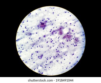 Right Axillary Swelling Secondary To Tuberculous Lymphadenopathy. Microscopic 40 X View