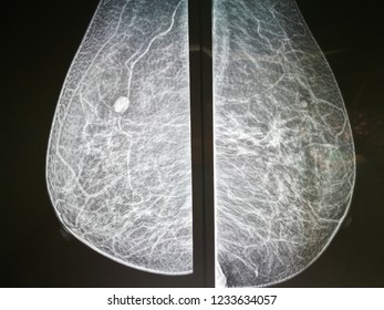 Right Breast Calcification showed in Mammogram in patient with Intraductal Breast Cancer.