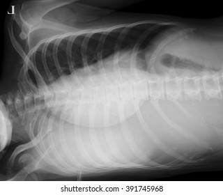 Right Decubitus Chest X-ray Image In A 28 Year Old Female, Acute Upper Respiratory Infection,