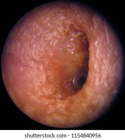 Right Ear: Acute Otitis Media. Condition After Inserting Of Tympanoventilation Tube