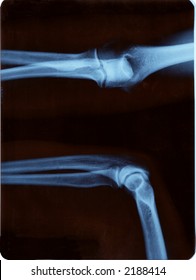 Right Elbow Radiography Open Closed Position Stock Photo 2188414 ...