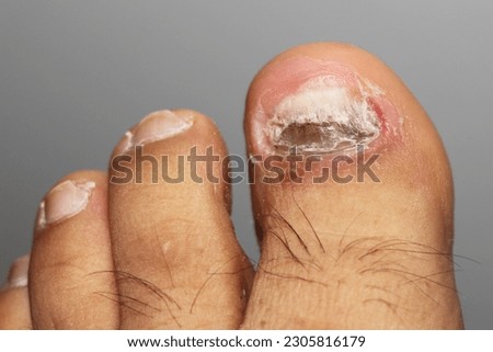 Right foot with fungus of an adult woman, with the nails completely destroyed and contagion with the other fingers.