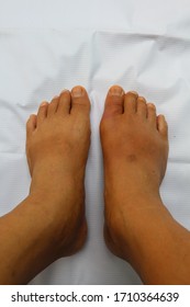 Right Foot Of A Man Suffering From Gout. It Has Pain, Swelling, Redness In The Right Toe.