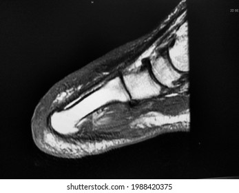 Right Foot MRI, Prior First Toe Amputation